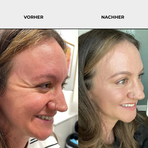 Beauty Skin Patches - Anti Falten Pflaster und Narbenpflaster